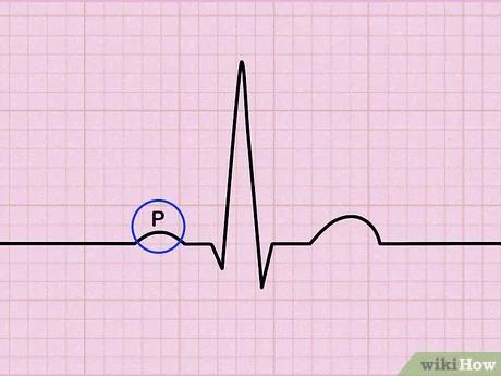 صورة عنوانها Read an EKG Step 3