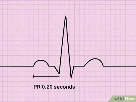 صورة عنوانها Read an EKG Step 4