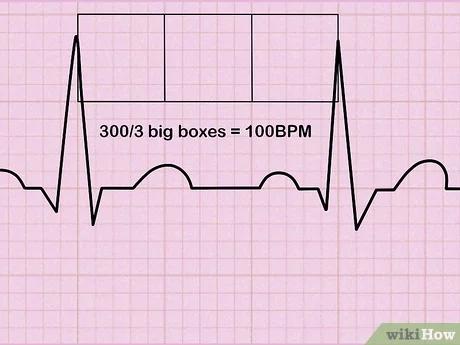 صورة عنوانها Read an EKG Step 6