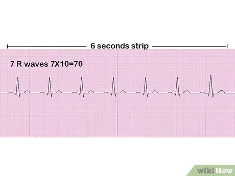 صورة عنوانها Read an EKG Step 7