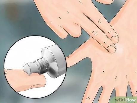 صورة عنوانها Reduce the Pain of Gnat Bites Step 5