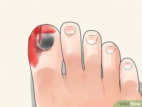 كيفية علاج إصبع القدم المرتطم